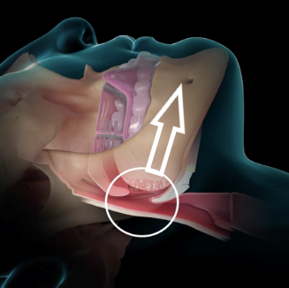 DAM ( Dispositivo de Adelantamiento Mandibular), Contacte con MyRespira para disponibilidad según zona geografica
